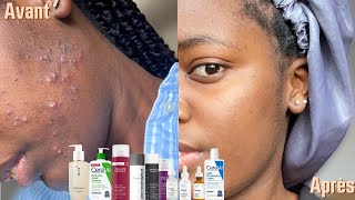 Lacné sur peau noire I Comment elle a sauvé sa peau en 2 mois avec 10 étapes simples  Partie 1 [upl. by Anirdnajela122]