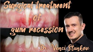 Surgical technique for treating gum recession Dr Venci Stankov [upl. by Ennyleuqcaj]