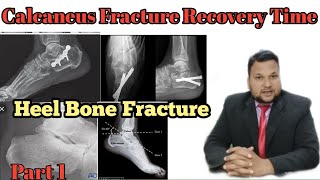 Calcaneus Fracture Recovery Time  Heel Fracture treatment  heel Fracture Recovery  in Hindi [upl. by Ettennor225]