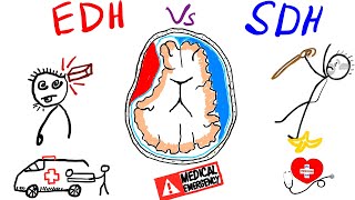 Extra duralEpidural Hematoma Vs Subdural Hematoma for Usmle Plab FCPS Medicine [upl. by Llemhar]