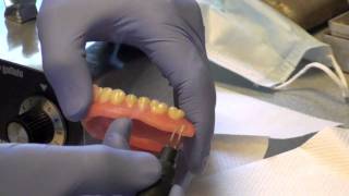 Denture Soft Reline Part 2 [upl. by Arda]