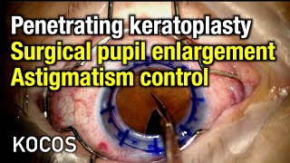 Penetrating keratoplasty surgical pupil enlargement astigmatism control [upl. by Crista]