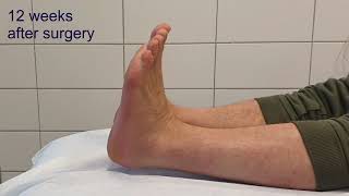 calcaneus fracture comminuted Sanders 4  minimal invasive surgery  clinical course [upl. by Ahsaela]