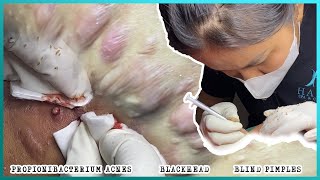 Big Cystic Acne Blackheads Extraction Blackheads amp Milia Whiteheads Removal Pimple Popping [upl. by Aracot]