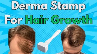 This Is Why You Should Add A Derma Stamp To Your Hair Growth Routine  Derma Stamp x Minoxidil Combo [upl. by Asus159]