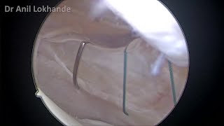 Arthroscopic Medial Retinaculum Plication amp Lateral Release Patella by Dr Anil Lokhande [upl. by Eldwen]