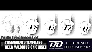 TRATAMIENTO TEMPRANO DE LA MALOCLUSION CLASE II [upl. by Slosberg]