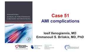 Case 51 PCI Manual  MI complications [upl. by Onavlis]