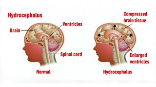 MENINGITIS BRAIN FEVER [upl. by Innus89]