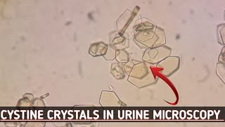 Cystine crystals seen in urine microscopyBest crystals view in microscopeUrine routine examination [upl. by Einneb]