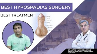 HYPOSPADIAS Surgery in Kolkata  Best Age for Hypospadias Surgery  Myths and Facts [upl. by Galanti]