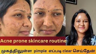 How I cleared my acne  Acne prone skincare routine  Products that I used for acne acneproneskin [upl. by Antonie300]