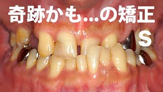 ガチャ歯 歯が悪い GVBDO Before amp After Braces Time Lapse 269 死にたいほど歯が悪かった人が復活した歯列矯正２６９日の記録。 [upl. by Jessa88]