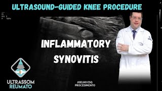 UltrasoundGuided Procedure in Knee Inflammatory Synovitis [upl. by Drofwarc]