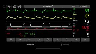 Electrical Alternans [upl. by Nnednarb]