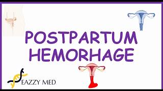 Postpartum Hemorrhage PPH causesrisk factorsprevention and treatment [upl. by Lachman]