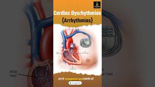 Cardiac Dysrhythmias Arrhythmia Part1  Types of Cardiac Arrhythmia Cardiac Dysrhythmias [upl. by Adna17]