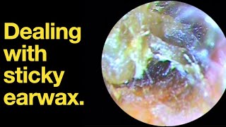 Dealing with sticky earwax ear wax removal  ear cleaning  ASMR  relaxation  relax [upl. by Maje]