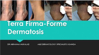 TERRA FIRMA FORME DERMATOSIS dermatology education skindisorder funny dirty [upl. by Mandelbaum53]