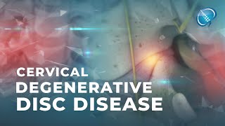 What is Cervical Degenerative Disc Disease  DDD [upl. by Blackmun176]