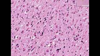 Histopathology BrainAstrocytoma [upl. by Paddy]