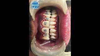 Class 2 div 1 Malocclusion  BRACES trending dentist toothdental dentalcare dentalclinic tooth [upl. by Lombard590]