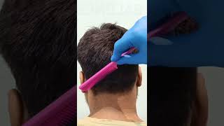 Hair Transplant result for 2400 grafts [upl. by Lumbye]