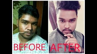 How to Remove Pimples in one day 100 working  Acne  Naturally [upl. by Hyde491]