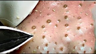 Best Satisfying Nose Plucking Blackheads Whiteheads Removal  Acne Treatment 19 [upl. by Ordnael]