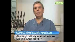 Gömülü Yirmilik Diş Ameliyatı Sonrası İyileşme Süreci Nasıldır [upl. by Cinom]