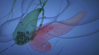 Causes of Gallstone Pancreatitis [upl. by Hamirak980]