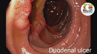 Duodenal ulcer l l endocut [upl. by Line]