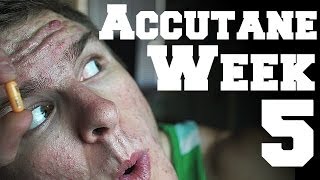 Weeks 15 Accutane Progress [upl. by Sandell]