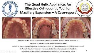 The Quad Helix Appliance An Effective Orthodontic Tool for Maxillary Expansion – A Casereport [upl. by Rowe]