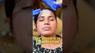 COSMELAN PEEL TREATMENT AT DRKASANAS CLINIC [upl. by Ennayehc]