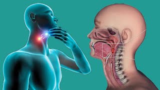 Throat Cancer Causes And Symptoms [upl. by Anderer]