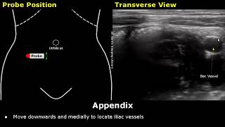 How To Scan Appendix  Ultrasound Probe Positioning  Transducer Placement  Abdominal USG Scanning [upl. by Josepha797]