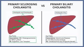 Primary Biliary Cholangitis vs Primary Sclerosing Cholangitis [upl. by Rhines]