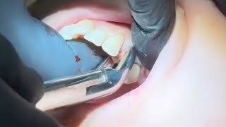 Extraction for First Maxillary Premolar [upl. by Jefferson12]