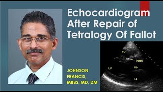 Echocardiogram After Repair of Tetralogy Of Fallot [upl. by Naerda]