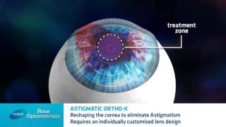 Astigmatism and Orthokeratology  Can Orthokeratology correct Astigmatism  Rose Optometrists [upl. by Waddington]