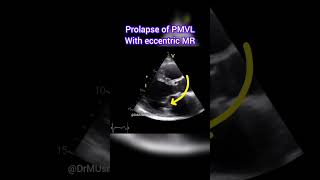 Prolapse of Posterior Mitral Valve Leaflet with Eccentric MR echocardiogram echocardiography [upl. by Gwenneth]