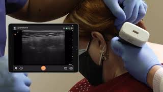 Scanning Technique Occipital Nerve Block [upl. by Yanal]