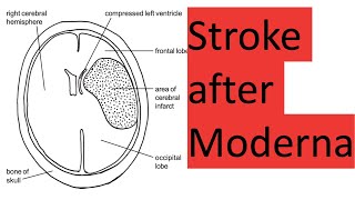 Stroke and death after Moderna [upl. by Rexferd]