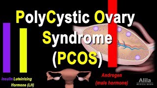 Polycystic Ovary Syndrome PCOS Pathology and Treatment Animation [upl. by Pfeffer314]