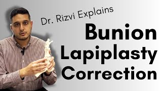 3D Bunion Correction Lapiplasty Bunion Procedure  Dr Rizvi Explains [upl. by Prasad]