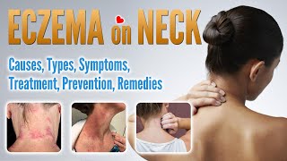 Eczema on neck Causes Types Treatment Prevention and Natural Home Remedies  Neck Dermatitis [upl. by Akerdnuhs790]