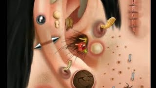 Itchy amp Smelly Ear Stone Removal Digging Out Super Big Earwax [upl. by Gensler760]