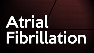 Atrial Fibrillation ECG [upl. by Bonis9]