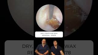 DRY CRISPY EAR WAX REMOVAL  EP878 [upl. by Hartman706]